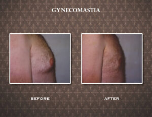 Dr. Charles Messa - What is Gynecomastia?