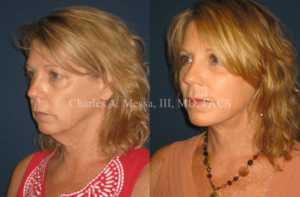 Facelift Before & After Photos