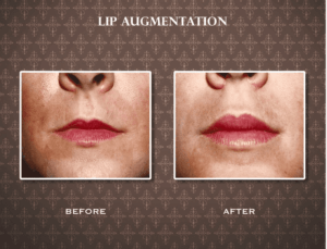 Dr. Charles Messa - Injectables for Luscious Lips