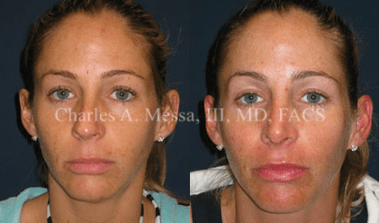 Dr. Charles Messa - Achieving Your Best Nose: Rhinoplasty