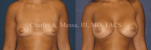 Dr. Charles Messa - Am I Too Old for a Breast Augmentation?