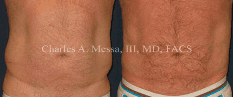 Dr. Charles Messa - Men Want a Slimmer Appearance Too!