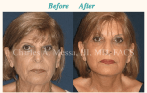 Dr. Charles Messa - How to Get the Best Results With a Facelift