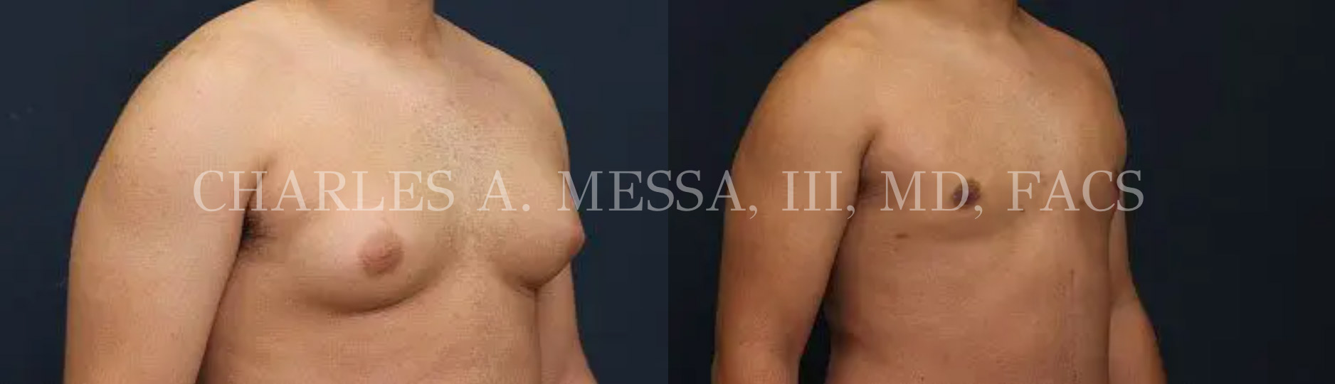before and after pictures of a gynecomastia surgery patient